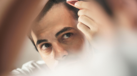 Un hombre aplica vitaminas en su alopecia