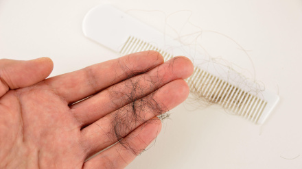 Un hombre pierde pelo en el peine
