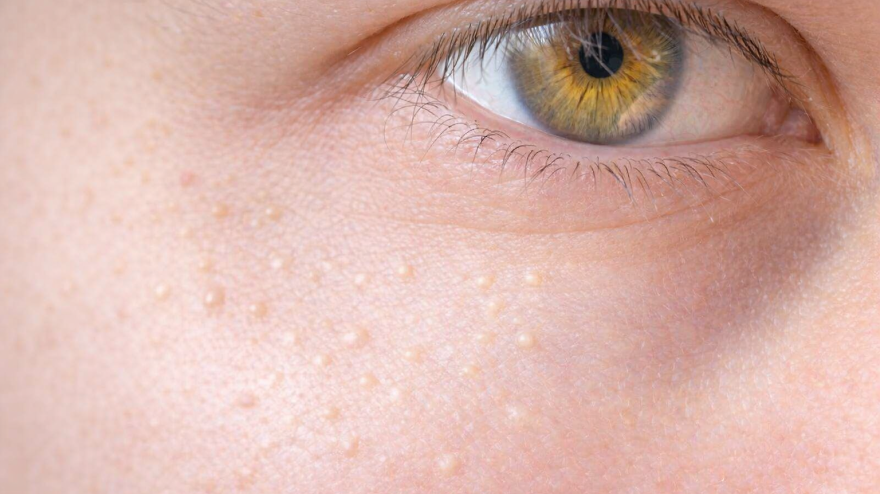 Las bolitas blancas en la piel