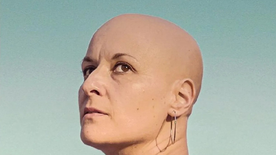 Mujer con alopecia
