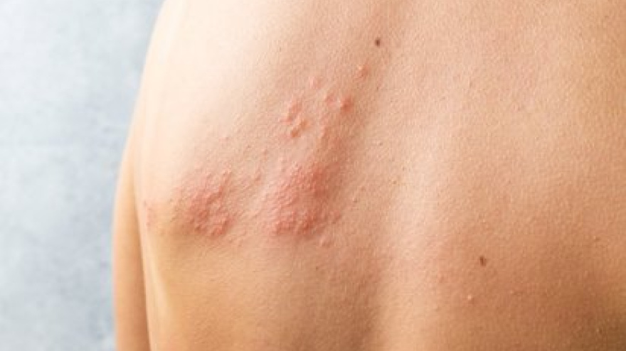 Infección en la piel causada por el virus herpes zóster