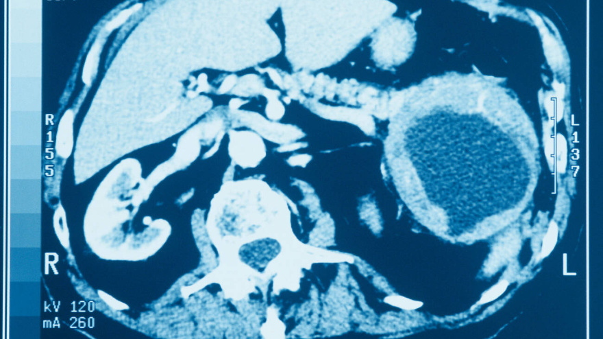 Cáncer de páncreas