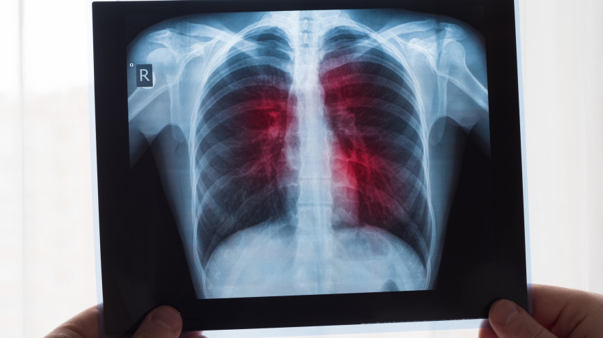 Radiografía de pulmones