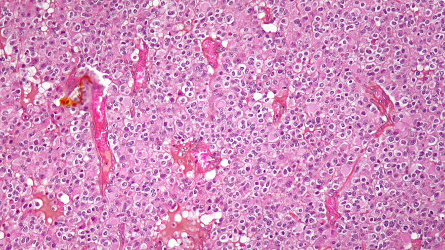 Micrografía de bajo aumento de un oligodendroglioma