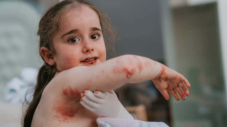 (Foto de ARCHIVO)Piel de mariposa.REMITIDA / HANDOUT por MARTÍN CORRADINIFotografía remitida a medios de comunicación exclusivamente para ilustrar la noticia a la que hace referencia la imagen, y citando la procedencia de la imagen en la firma16/8/2022