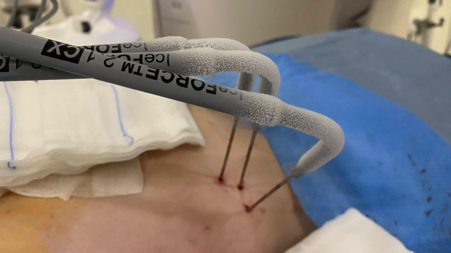 Agujas de crioablación con el hielo necesario para la intervención de tumores