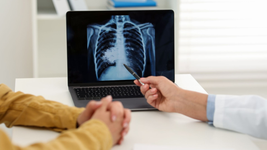 Los pulmones son los más afectados por la tuberculosis