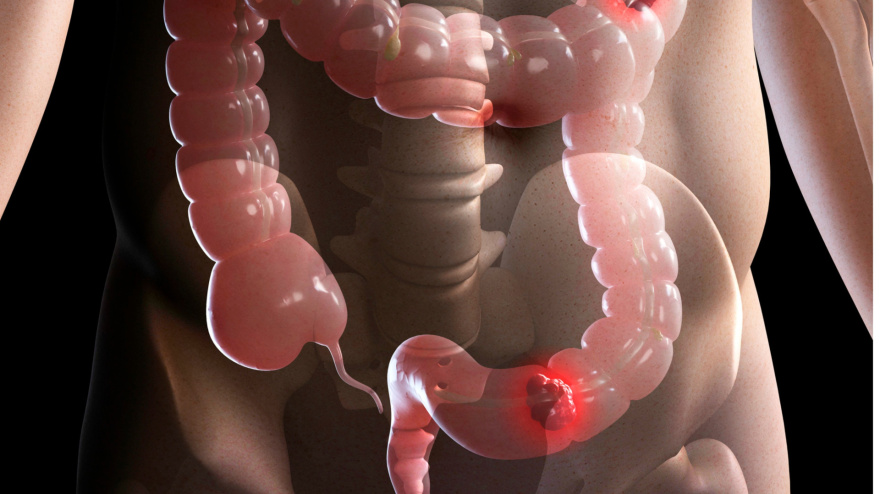 Cribado cáncer colon en La Rioja