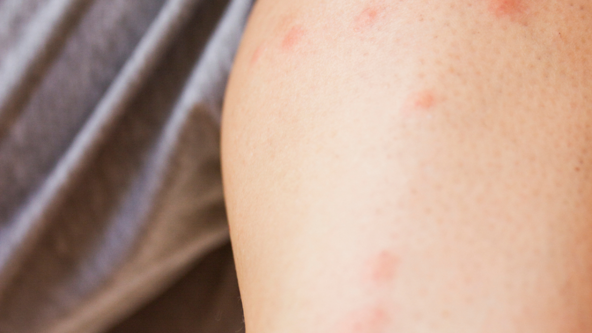 Los remedios para evitar que una picadura de mosquito te pique y se ...