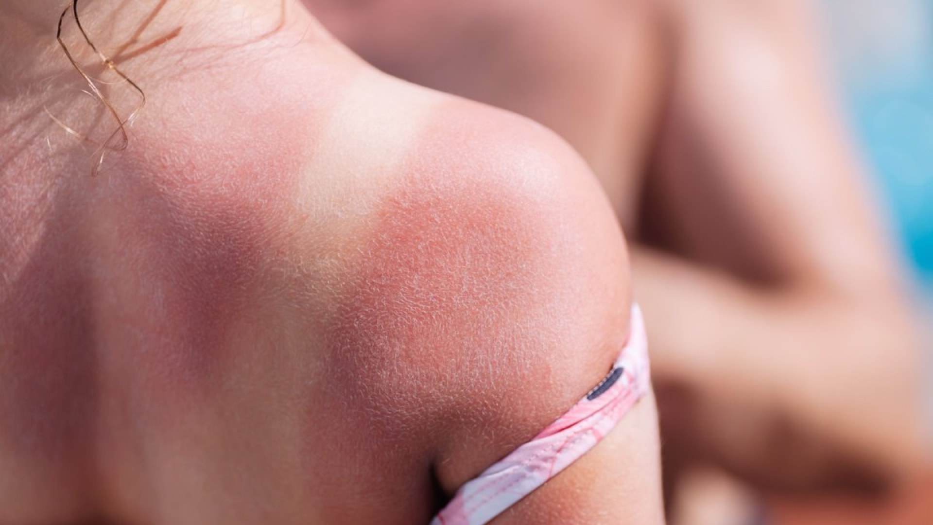 El sol, un enemigo silencioso: por qué debes protegerte los 365 días del año