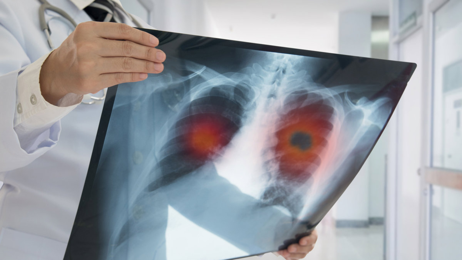 La clave para prevenir las enfermedades pulmonares graves según una neumóloga de Vithas