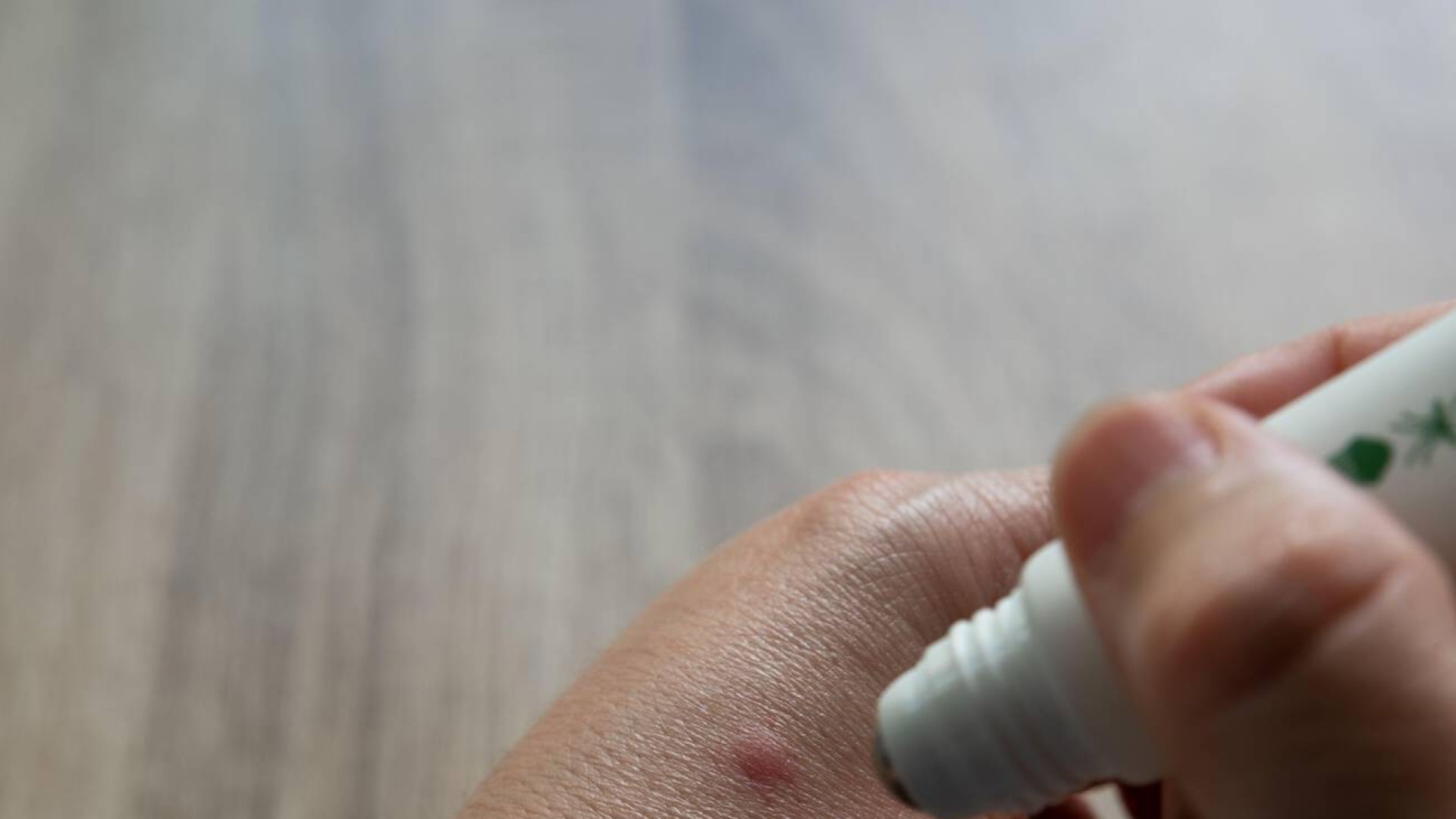 Una dermatóloga revela la "peor zona" en la que te puede picar un mosquito y que debería ponerte en alerta