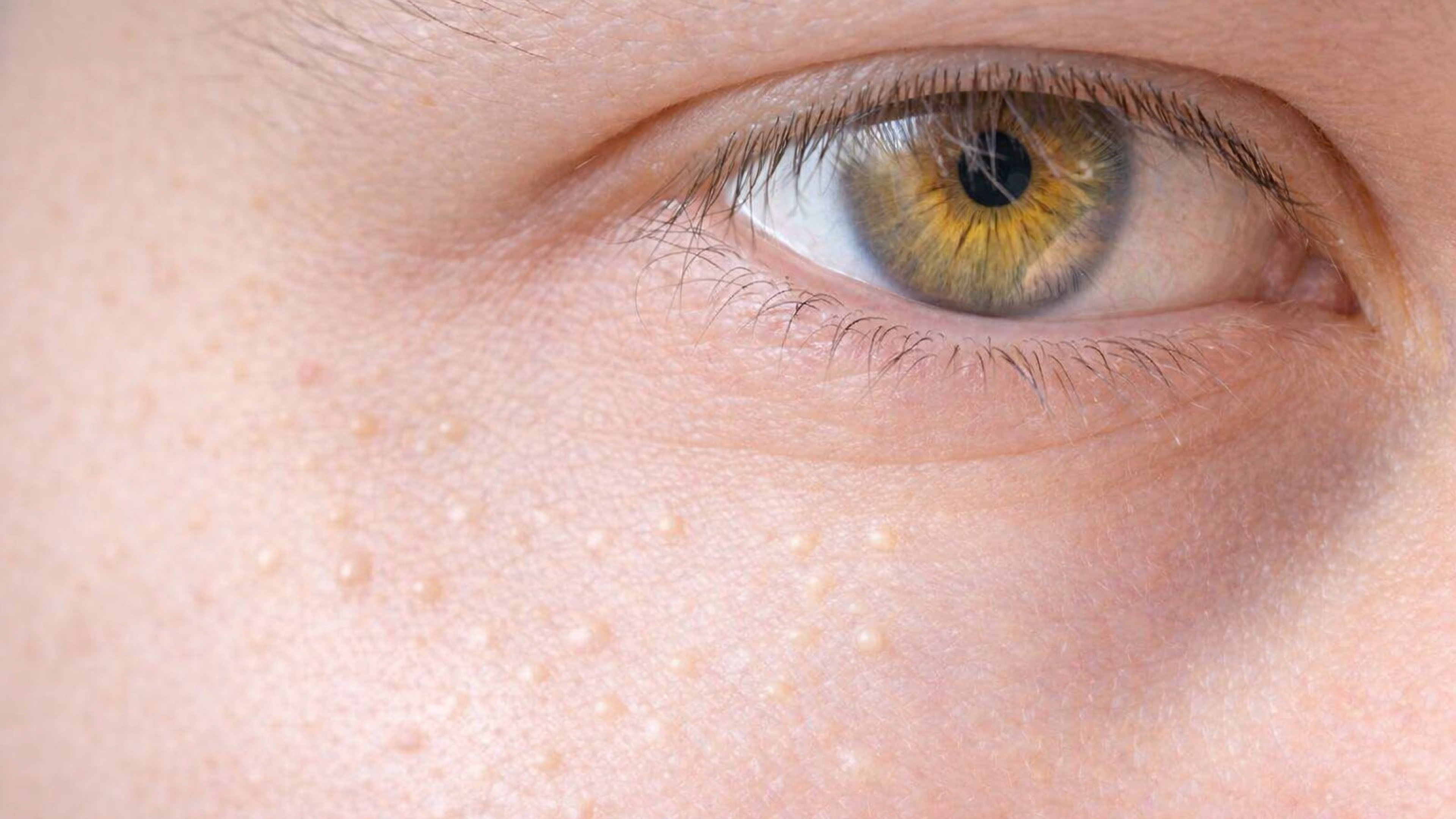 Cómo eliminar las pequeñas bolitas blancas de la piel