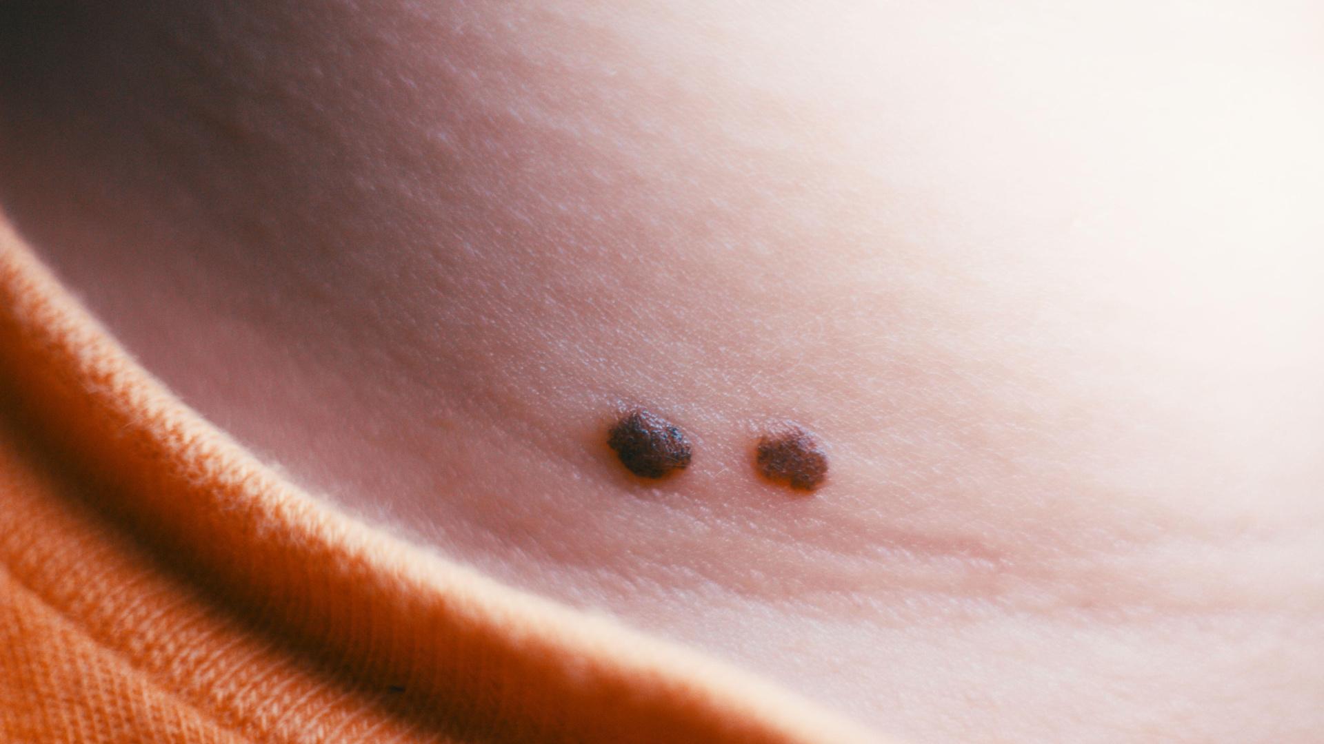 Moderna and Merck report positive skin cancer vaccine trial