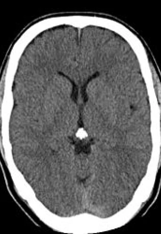 La glándula pineal tiene tendencia a calcificarse con la edad