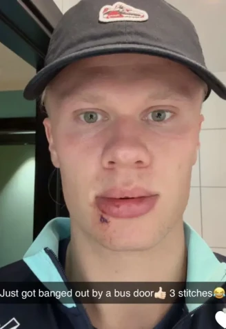 Erling Haaland de rompe el labio