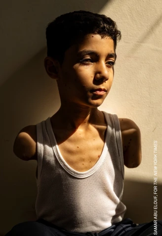 Mahmoud Ajjour, Aged NineCredit: © Samar Abu Elouf, for The New York Times Caption: Mahmoud Ajjour (9), who was injured during an Israeli attack on Gaza City in March 2024, finds refuge and medical help in Qatar. Doha, Qatar, 28 June 2024. Story: As his family fled an Israeli assault, Mahmoud turned back to urge others onward. An explosion severed one of his arms and mutilated the other. The family were evacuated to Qatar, where, after medical treatment, Mahmoud is learning to play games on his phone, write, and open doors with his feet. Mahmoud’s dream is simple: he wants to get prosthetics and live his life as any other child. Children are disproportionately impacted by the war. The UN estimates that by December 2024, Gaza had the highest number of child amputees per capita anywhere in the world. The photographer, who is from Gaza and was herself evacuated in December 2023, lives in the same Doha apartment complex as Mahmoud. She has bonded with families there, and documented some of the few badly wounded Gazans who made it out for treatment.
