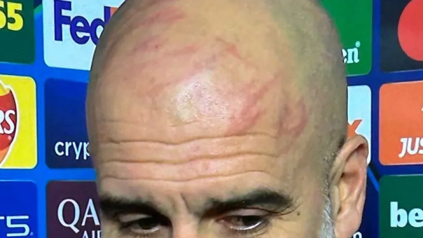 Las heridas de Guardiola en la cabeza tras el empate ante el Feyenoord