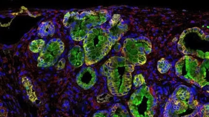 Cáncer de páncreas - EFE