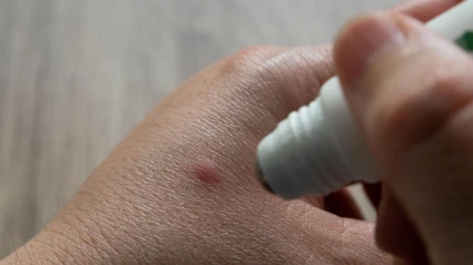 Picadura de mosquito