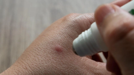 Picadura de mosquito