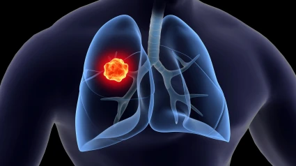2B9EF48 Medical illustration of lung cancer inside the human lungs.