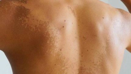 Como cuidar tu piel tras el sol