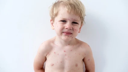 Un niño con las lesiones típicas que provoca el sarampión, una infección que se había declarado erradicada en España