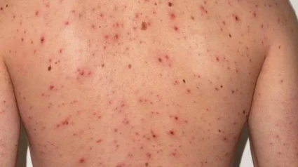 Síntomas del sarampión