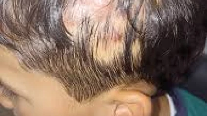 Ejemplo de un niño con tiña, ajeno a esta entrevista