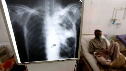 Un paciente de tuberculosis en un hospital.