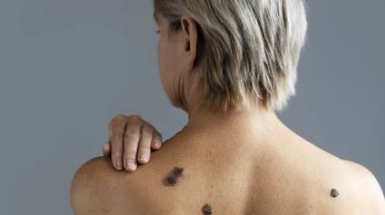 El melanoma ha subido su tasa de incidencia