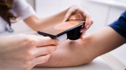 Un estudio revela que el melanoma se ha duplicado en mayores de 65 años en el sur de Sevilla