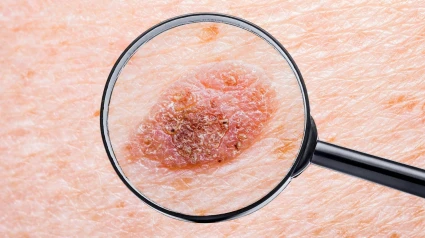 Cáncer de piel