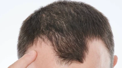 Alopecia