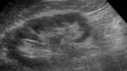 Ecografía de riñón