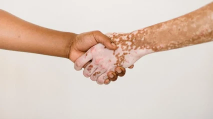 Vitiligo
