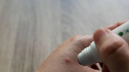 Picadura de mosquito en la mano