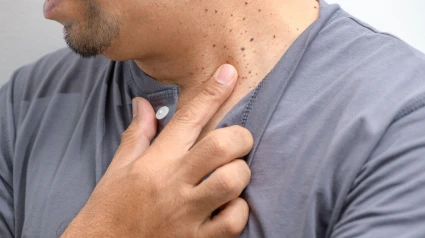 Un hombre con verrugas en el cuello