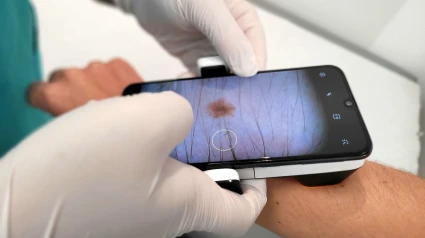 Dermatoscopio-Teledermatología