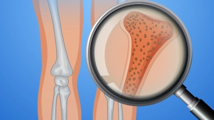 OSTEOPOROSIS