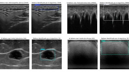 Un sistema de inteligencia artificial permite identificar rellenos estéticos en la piel mediante ecografías