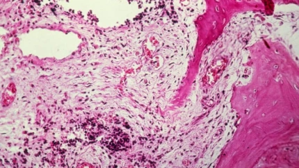El sarcoma de Edwing es un tipo de cáncer que aparece en la adolescencia