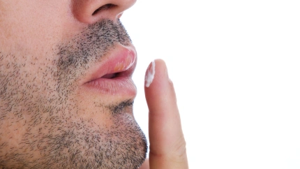 Aplicación de crema para el tratamiento médico del herpes labial en la boca de un hombre.