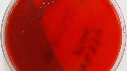 (Foto de ARCHIVO)Meningitis01/6/2017