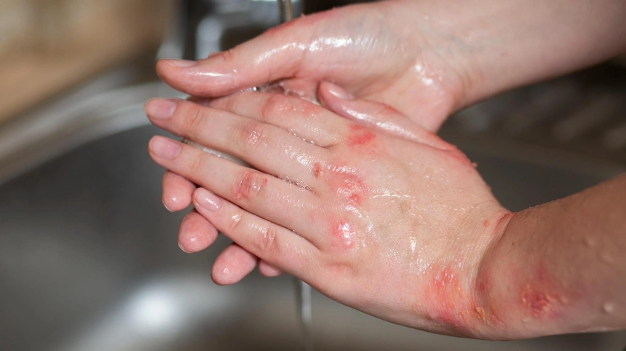 El error que casi todos cometemos en invierno y que destroza la piel