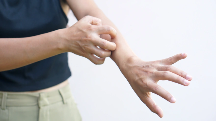 ¿Es la sarna la nueva pandemia?