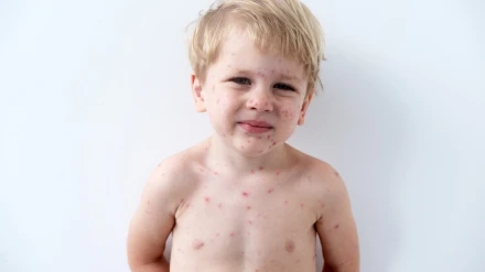 Un niño con las lesiones típicas que provoca el sarampión, una infección que se había declarado erradicada en España