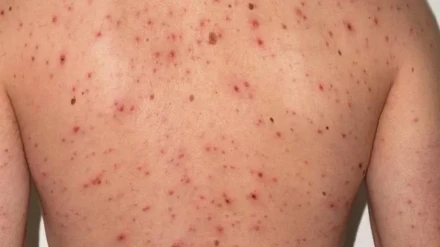 Síntomas del sarampión