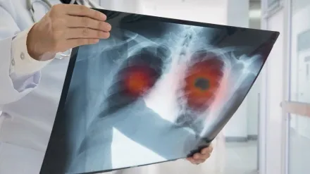 Imagen sobre una tumoración pulmonar